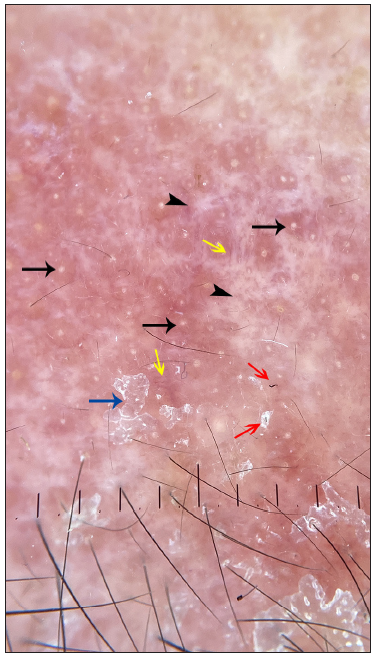Dermoscopy of the eyebrow lesion showed white areas (black arrowhead) surrounding the follicle plugging (black arrow) with a few short linear vessels (yellow arrow) at the periphery of follicles. Scales (blue arrow) and a few broken hairs (red arrow) are seen along with pinkish areas (polarising, 10x)